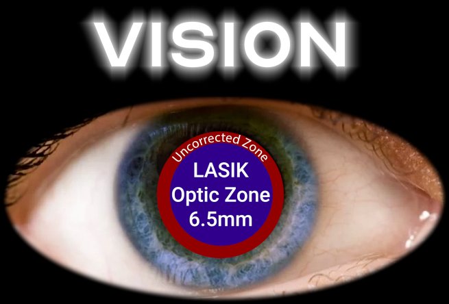 After LASIK - smaller optical zone