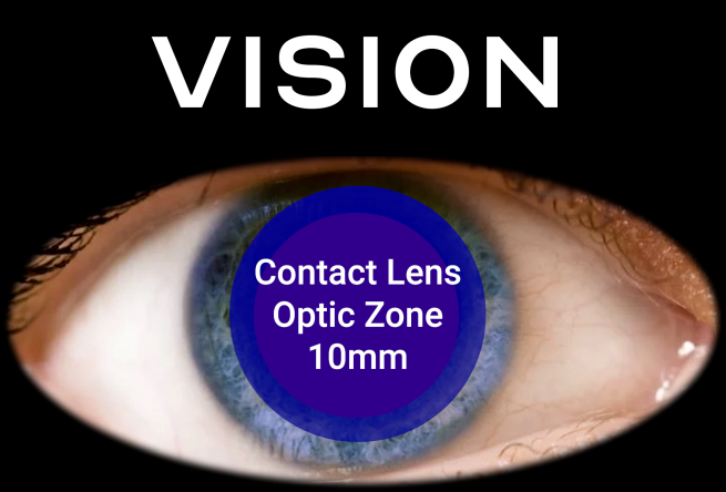 Before LASIK - full optical zone with glasses/contacts