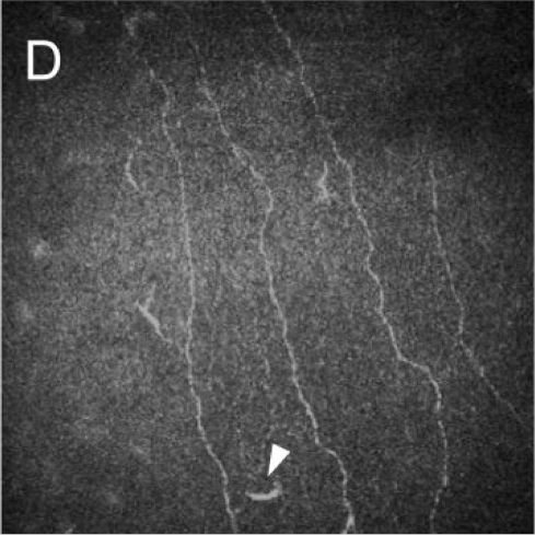 After LASIK - reduced corneal nerve density