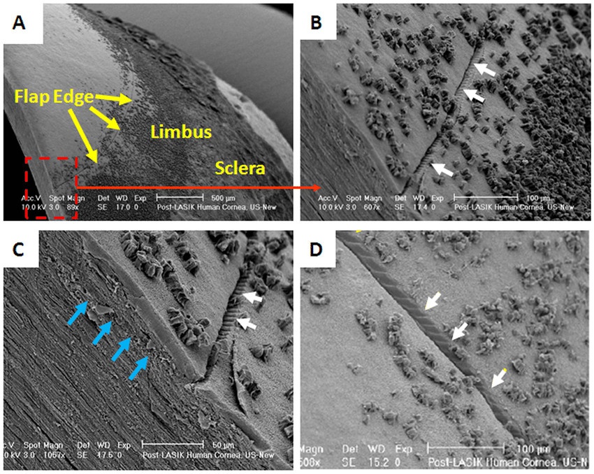 Electron Microscopy Damage from LASIK