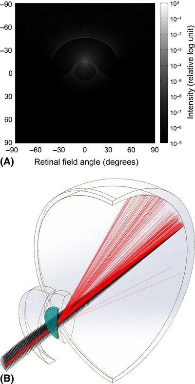 ICL central hole causes vision distortions like ring-shaped dysphotopsia