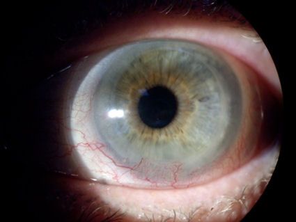 Eye with post-LASIK complications
