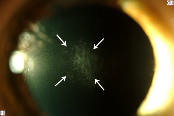 Corneal haze after PRK